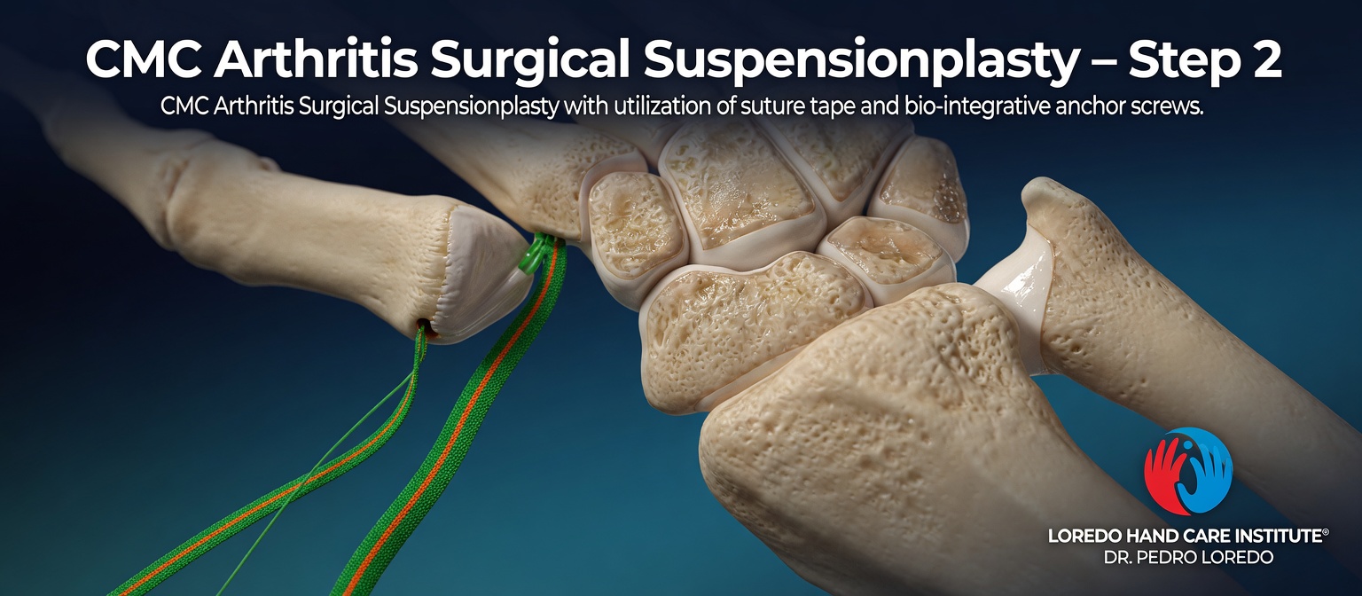 Step 2 of CMC arthritis surgery showing the suspensionplasty technique with high-strength suture tape (green and orange) being threaded between the thumb metacarpal and adjacent stable bone using bio-integrative anchor screws. Created for Loredo Hand Care Institute by Dr. Pedro Loredo.